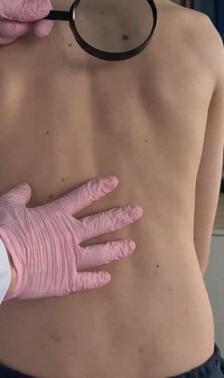 Uklanjanje mladeža i drugih kožnih i mekotkivnih promena Novi Sad – plastična i estetska hirurgija