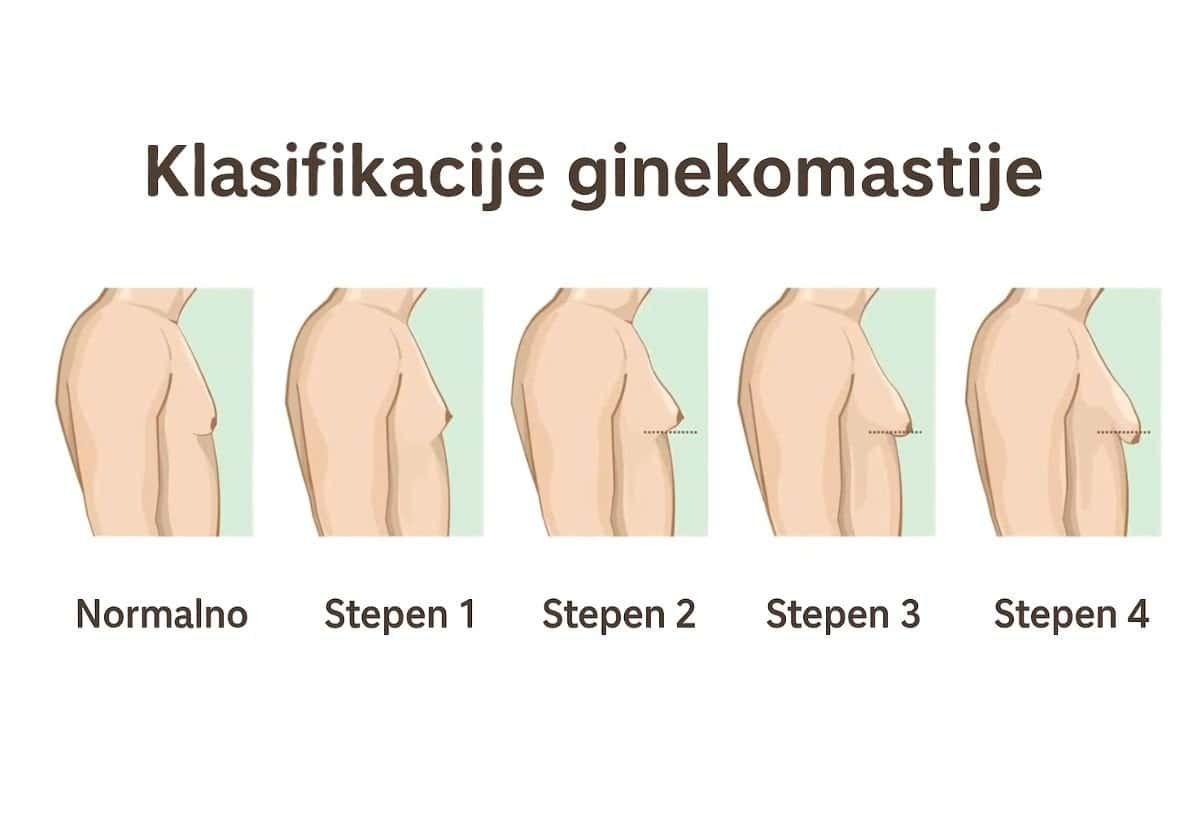 klasifikacija ginekomastije