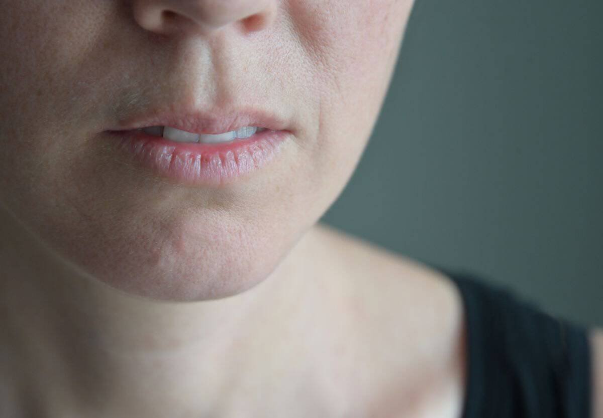 kandidat za lip lift zatezanje usne novi sad