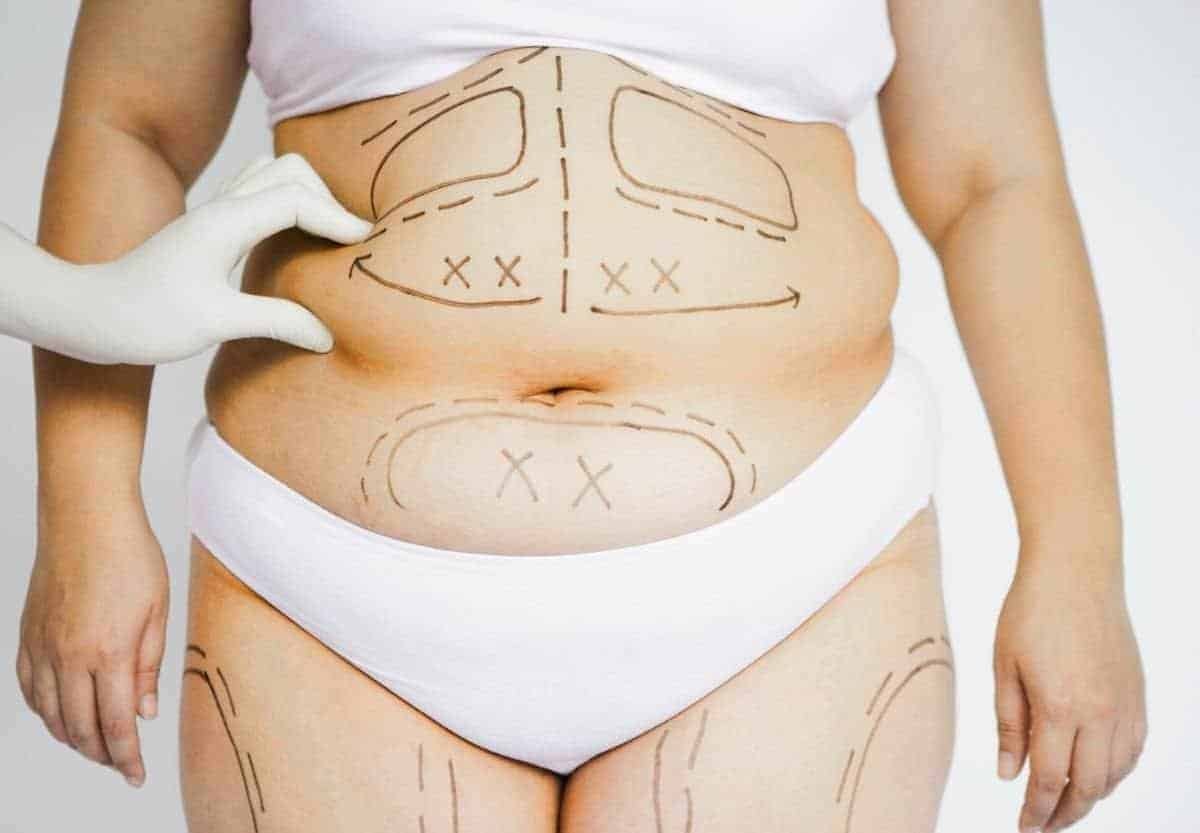 ko je dobar kandidat za liposukciju novi sad