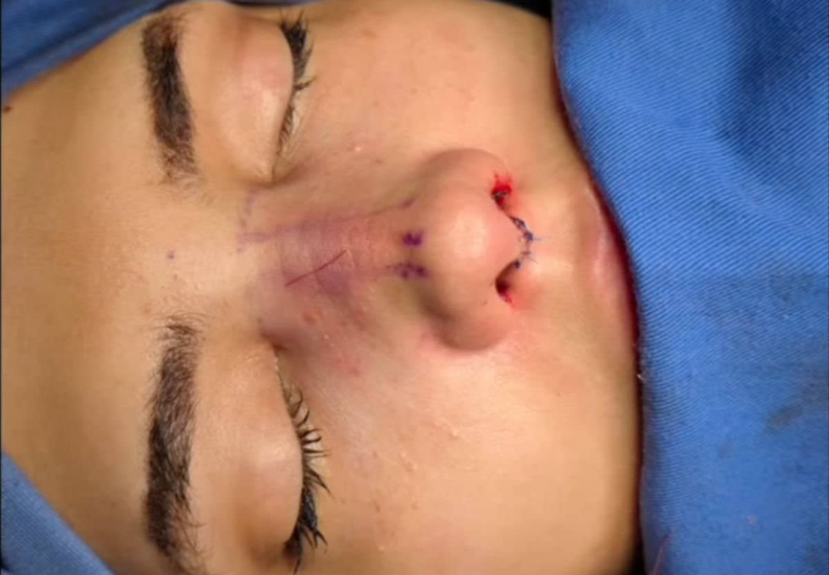 piezo rinoplastika manje modrica i oziljaka